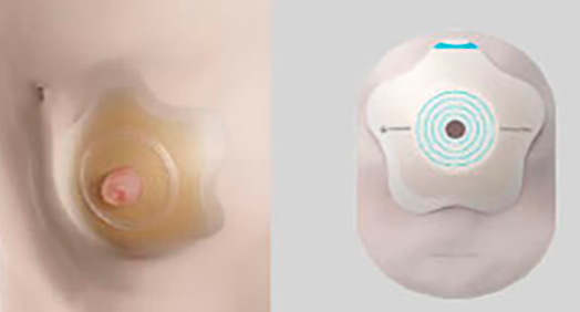 SenSura Mio Concave – nové řešení pro stomie