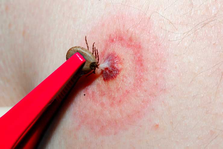 Kousnutí klíštětem - zarudnutí - Pomocí domácího testu Veroval snadno zjistíte, zda se v daném klíštěti vyskytují bakterie borélie a zda tedy můžete být nakaženi Kousnutí klíštětem zarudnutí - Veroval® Borélie z klíštěte - domácí test